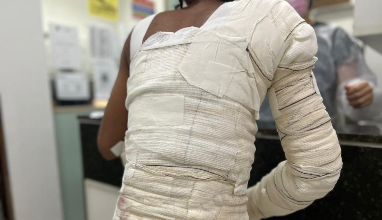 Paciente com queimaduras